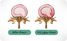 آیا پیاده روی برای پارگی دیسک کمر ضرر دا