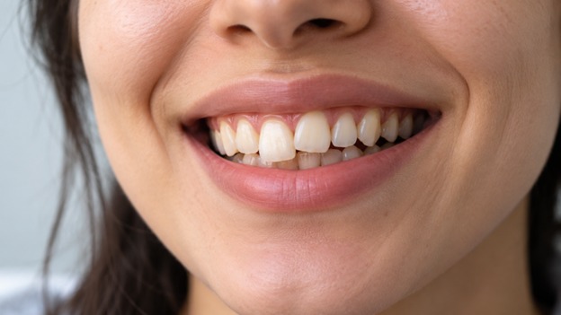 دندان جلوی کج را چگونه صاف کنیم؟ مقایسه ارتودنسی، الاینر شفاف و کامپوزیت