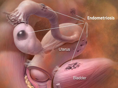 اندومترویز چیست بیماری اندومتریوز