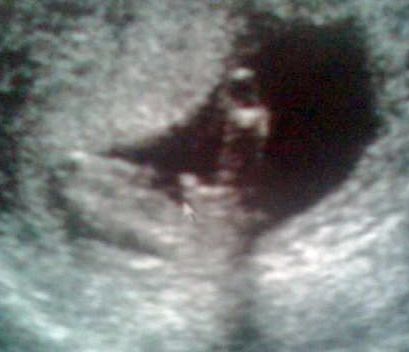 عکس جنین پسر در سونوگرافی هفته سیزدهم بارداری عکس جنین پسر در سونوگرافی هفته سیزدهم بارداری