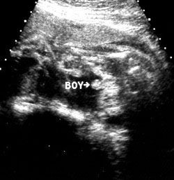 هفته سی و سوم بارداری هفته سی و سوم بارداری