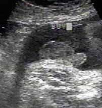 عکس جنین در سونوگرافی هفته سی وهفتم بارداری عکس جنین در سونوگرافی هفته سی  هفتم بارداری