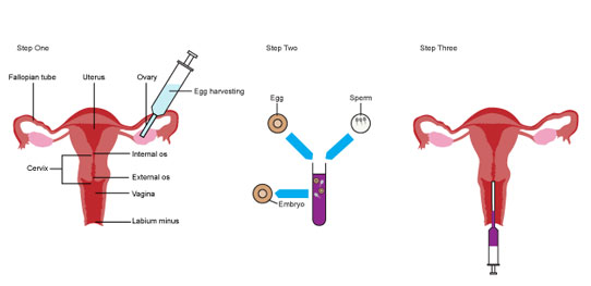 ivf چگونه انجام میشود ivf چگونه انجام میشود