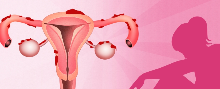 درمان خانگی آندومتریوز درمان خانگی آندومتریوز