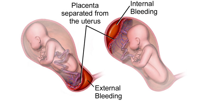 جدا شدن جفت از رحم جدا شدن جفت از رحم