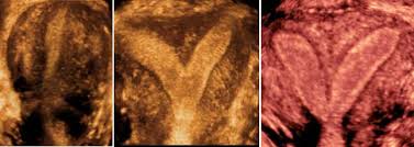 سونوگرافی واژینال در بارداری سونوگرافی واژینال در بارداری