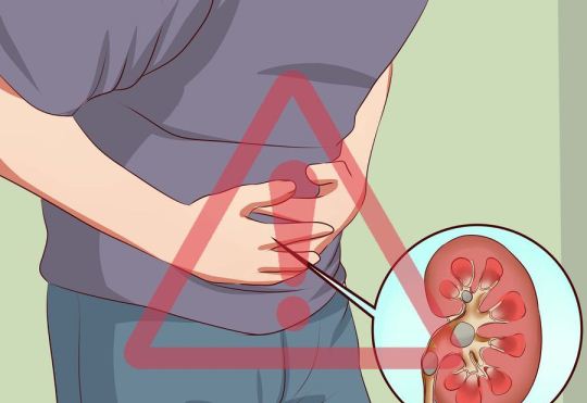 سابقه خانوادگی در دفع سنگ کلیه