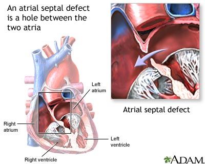 مشکلات قلبی در سندرم داون