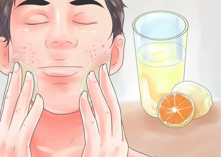 از بین بردن سریع جای جوش با آب لیموی تازه از بین بردن سریع جای جوش با آب لیموی تازه