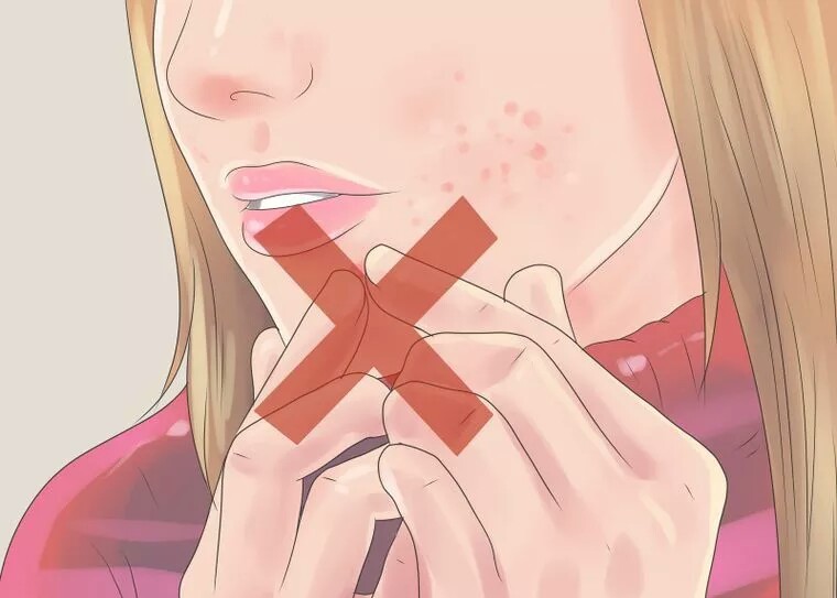 اجتناب از کندن جوش اجتناب از کندن جوش