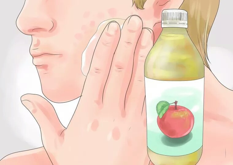 از بین بردن سریع جای جوش با سرکه سیب از بین بردن سریع جای جوش با سرکه سیب