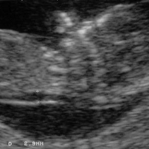 سونوگرافی NT سونوگرافی NT