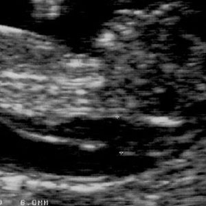 سونوگرافی NT سونوگرافی NT