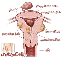 انواع میوم