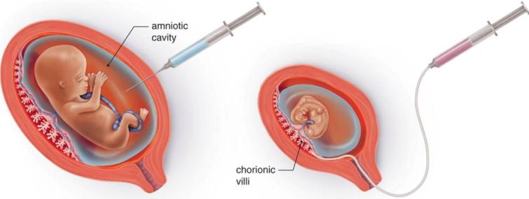  CVS و آمنیوسنتز