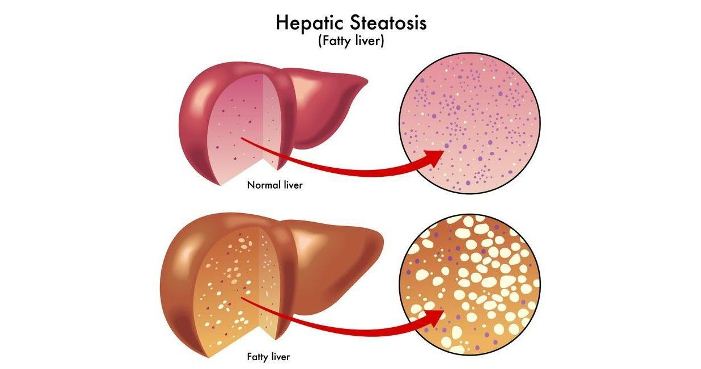 کبد چرب چیست