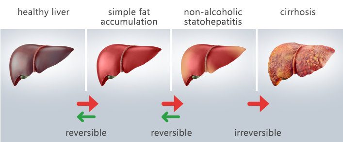 انواع کبد چرب و گرید آن