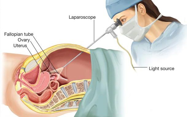 زمان انجام لاپاراسکوپی  زمان انجام لاپاراسکوپی
