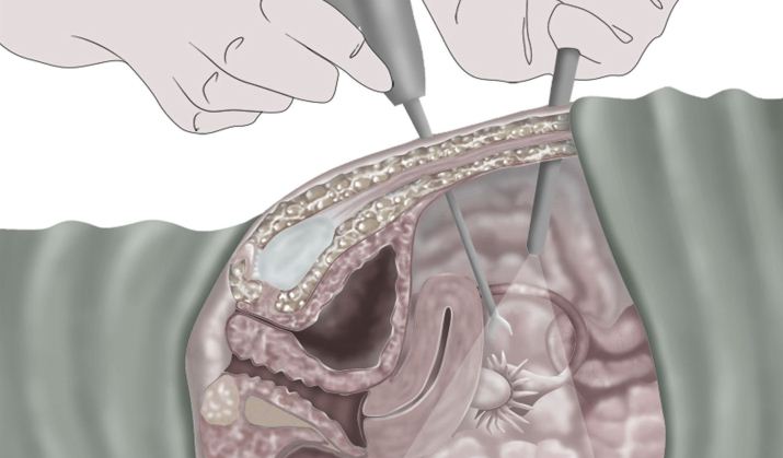 عمل لاپاراسکوپی چیست عمل لاپاراسکوپی چیست