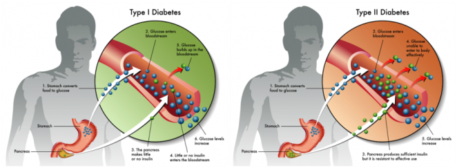 عامل ایجاد دیابت نوع 1 و 2