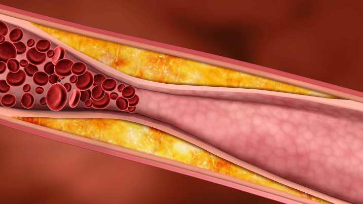 چه چیزی باعث فشار خون میشود؟