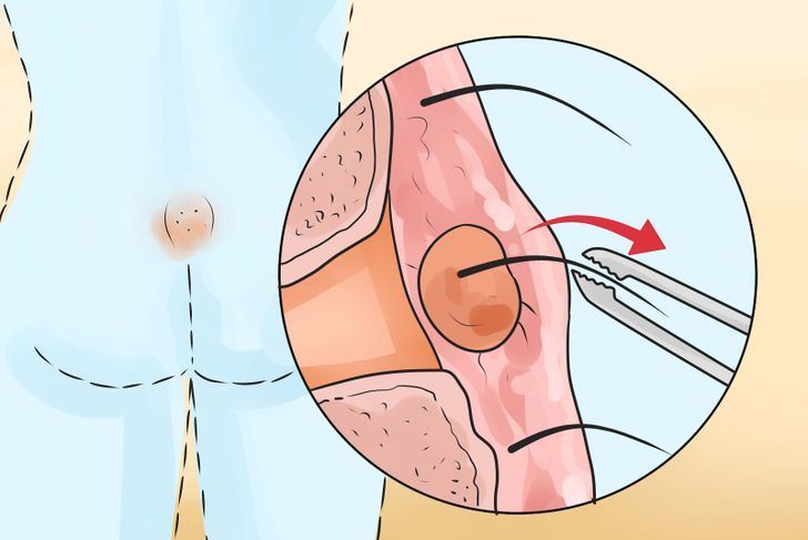 درمان کیست مویی درمان کیست مویی