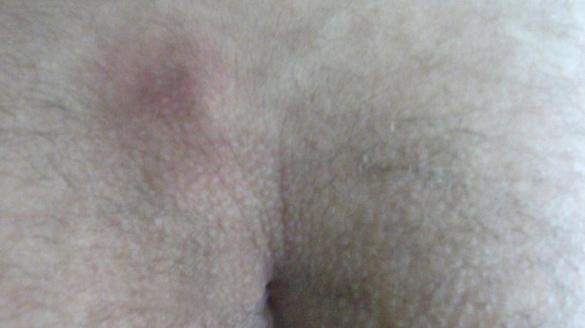 عکس کیست مویی عکس کیست مویی