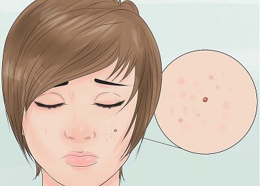 ترکاندن جوش باعث قرمزی اطراف آن می شود