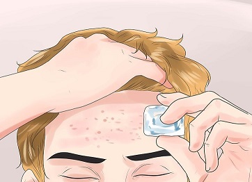 درمان جوش های صورت 