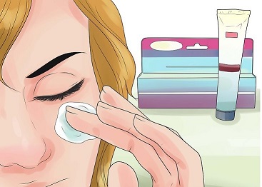 پراکسید بنزوئیل و بهبود جوش های صورت