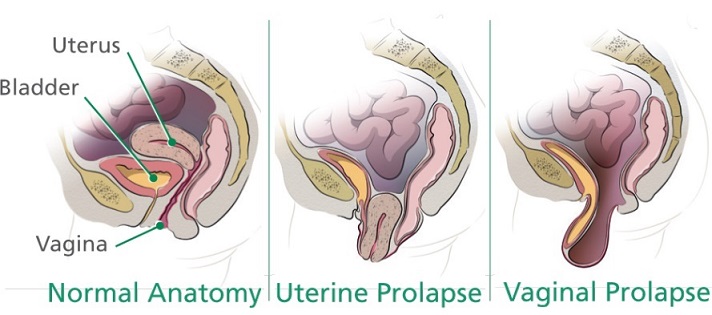 حقایق افتادگی رحم