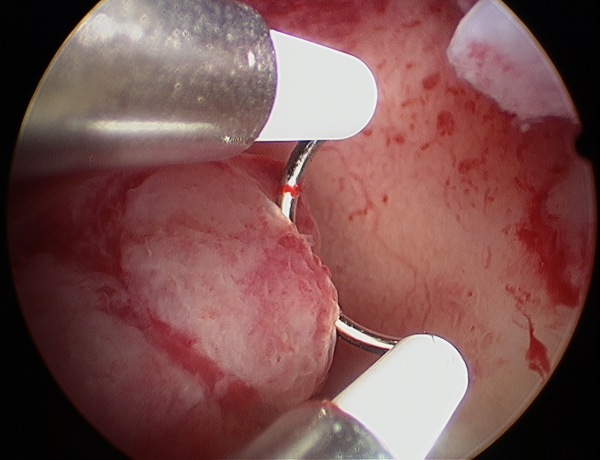 درمان چسبندگی رحم درمان چسبندگی رحم