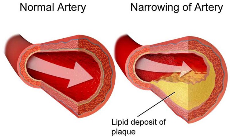 علت ابتلا به چربی خون علت ابتلا به چربی خون
