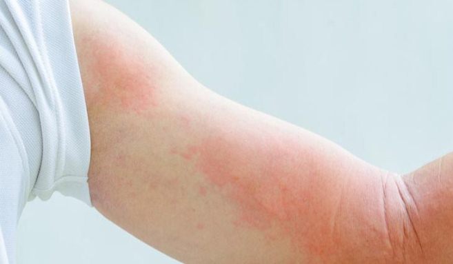 انواع کهیر انواع کهیر