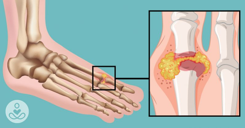زمان مراجعه به پزشک برای نقرس