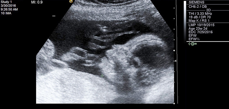 تفسیر جواب سونوگرافی آنومالی تفسیر جواب سونوگرافی آنومالی