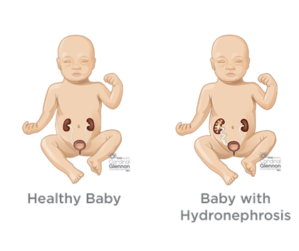 معیار تشخیصی ورم کلیه جنین معیار تشخیصی ورم کلیه جنین