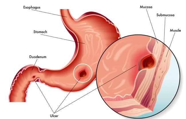 علت زخم معده
