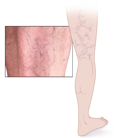 علت ایجاد واریس چیست علت ایجاد واریس چیست