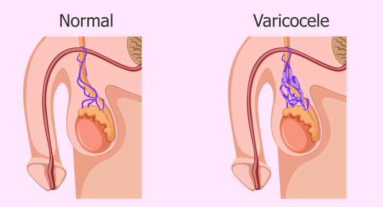 درمان واریکوسل درمان واریکوسل