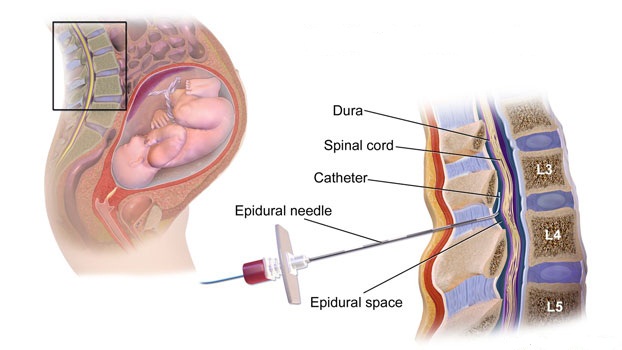 بی حسی اپیدورال