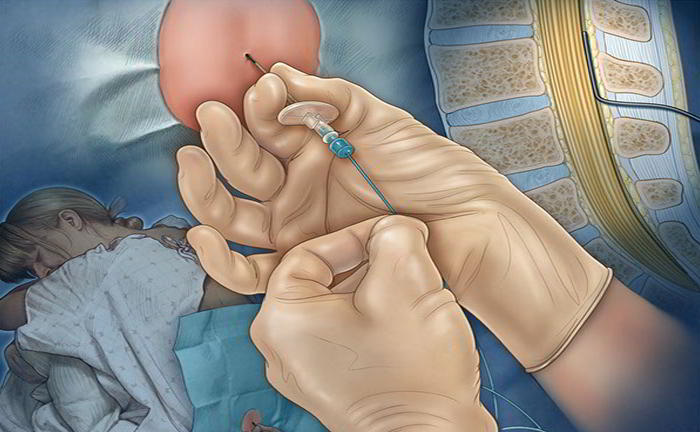 سوالات متداول در مورد اپیدورال ها