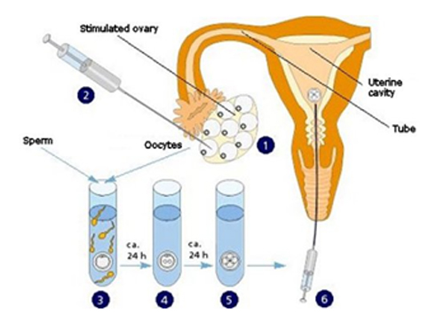 روش میکرواینجکشن