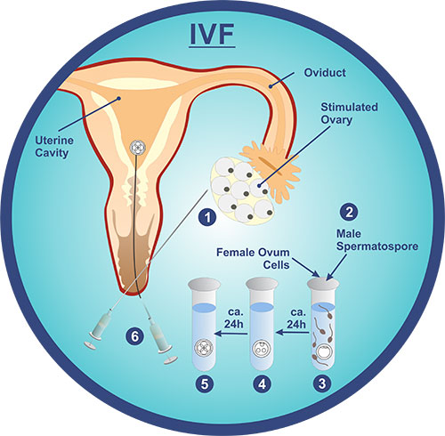 روش ای وی اف