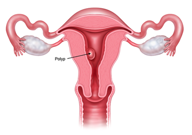 علائم پولیپ رحم چیست علائم پولیپ رحم چیست