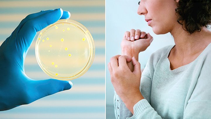 درمان دارویی و خانگی اگزما درمان دارویی و خانگی اگزما