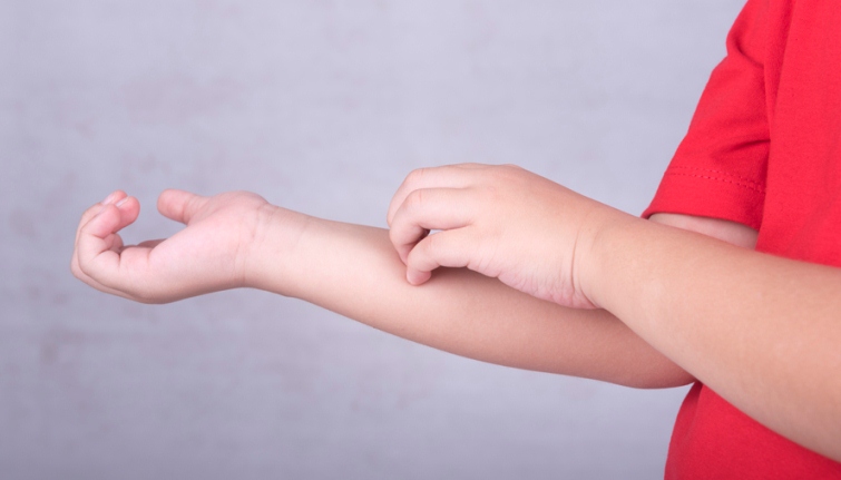 علائم اگزما چگونه است؟ علائم اگزما چگونه است؟