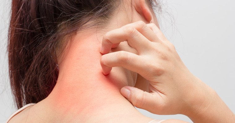 انواع اگزما انواع اگزما