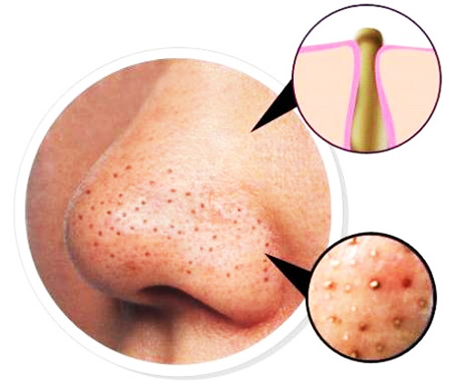 جوش سرسیاه جوش سرسیاه