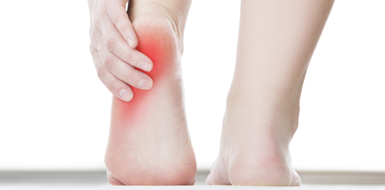 19 درمان خانگی خار پاشنه 19 درمان خانگی خار پاشنه